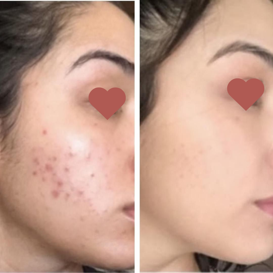 Pele sem acne após tratamento natural - antes e depois