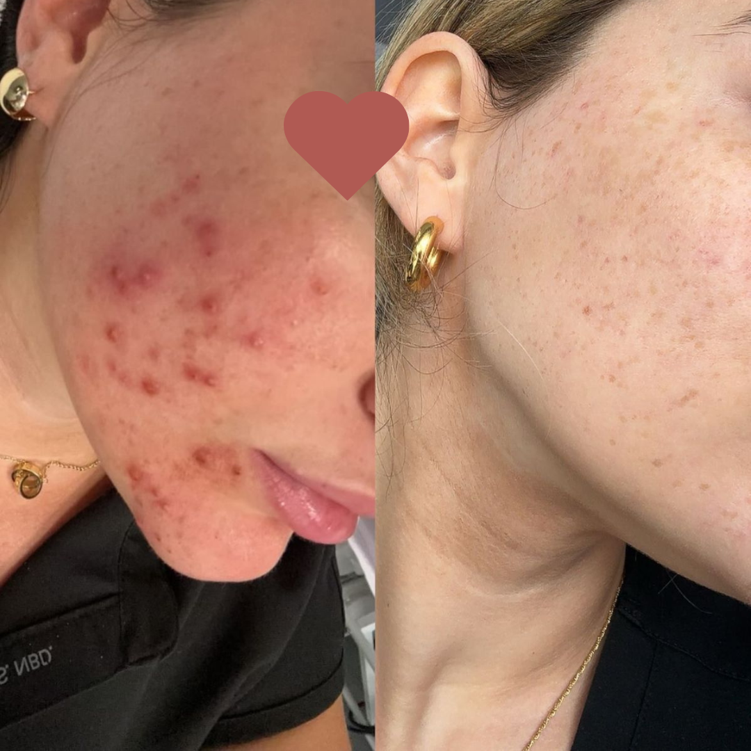 Adeus acne - antes e depois do tratamento