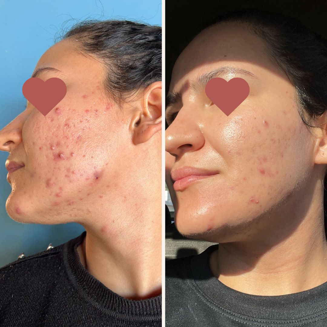 Pele limpa e saudável com o método Livre de Acnes